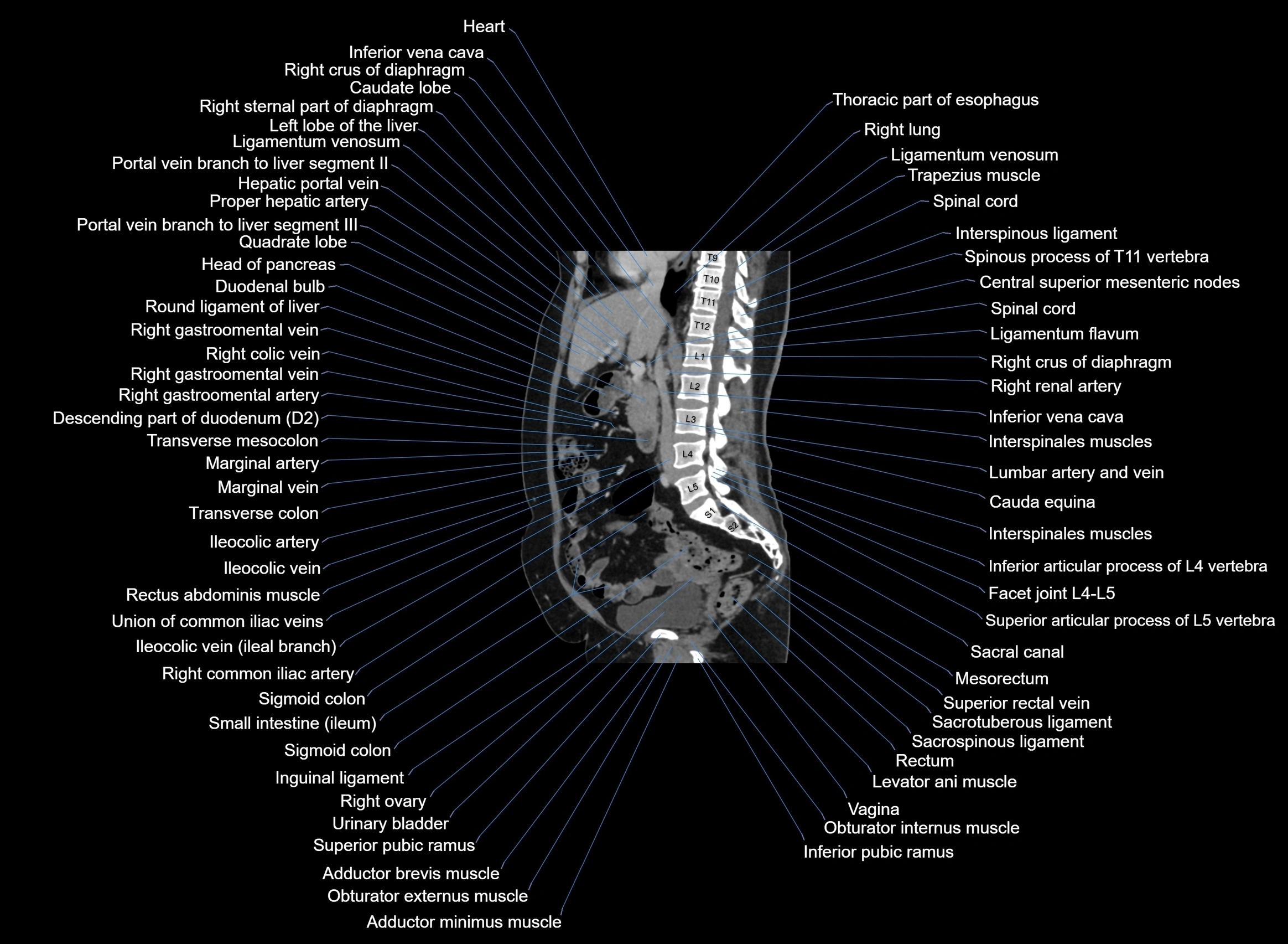 CT Abdomen sagittal cross sectional anatomy labelled radiology image -00064.webp